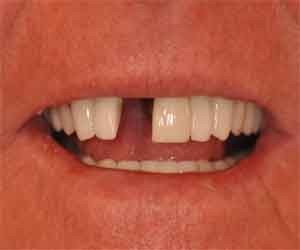 without dental implants