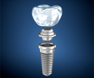 Dental Implants London at Behrens