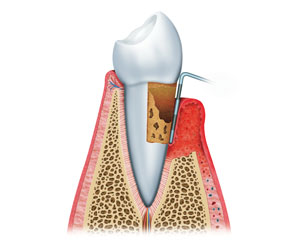 Periodontal Treatment at Behrens Dental Practice