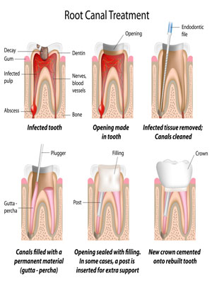 root canal treatment London