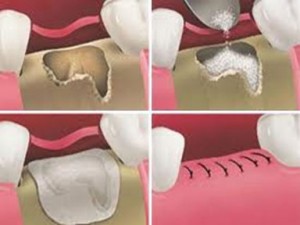 repairing gums