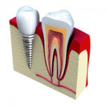 Dental Implants at Behrens Dental Practice