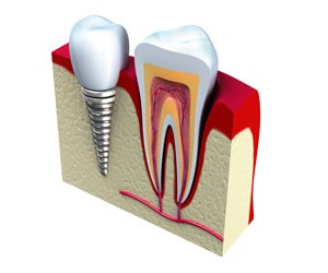 Dental Implants at Behrens Dental Practice