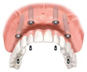 Multiple tooth replacement Behrens Dental Practice
