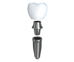 single tooth dental implants london