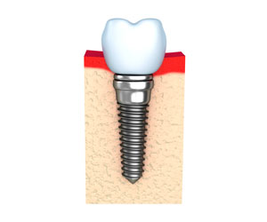 single-implant3