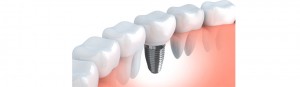 single tooth implant