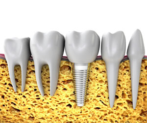 single tooth dental implants south kensington