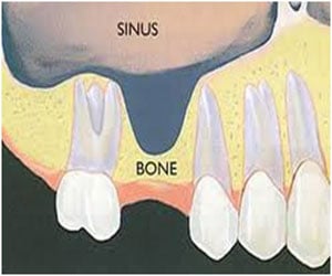 Sinus Graft in Detail