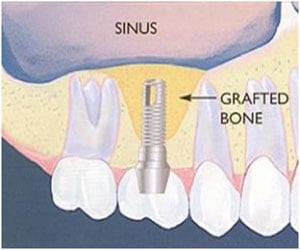 Sinus Graft in Detail