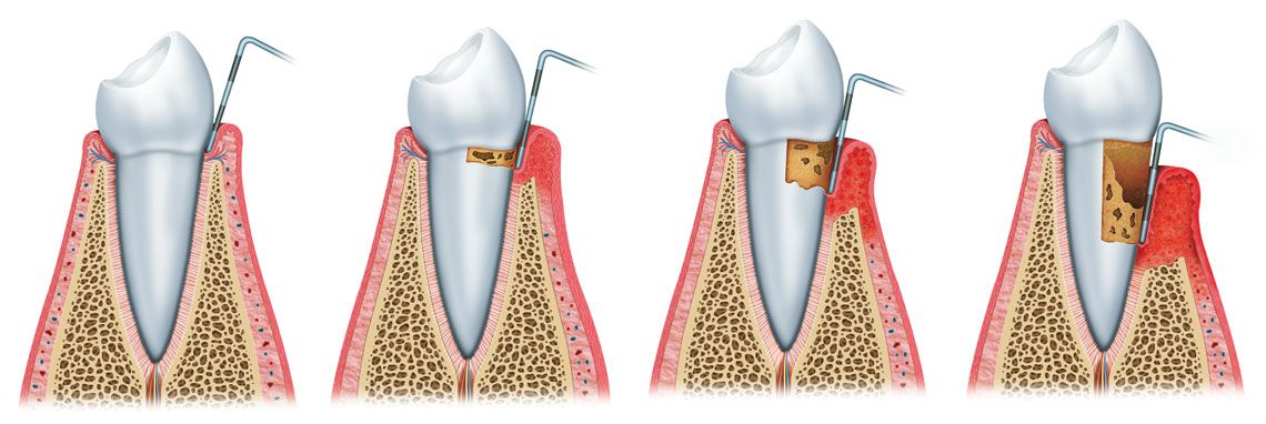 stages periodontal disease