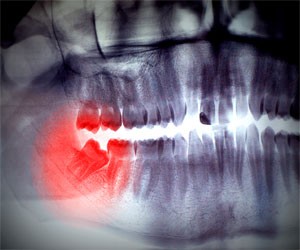Wisdom tooth removal London at Behrens Dental Practice