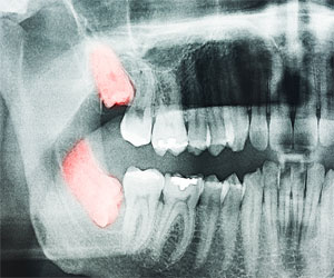 x ray wisdom teeth behrens dental practice