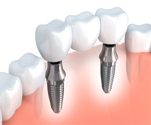 multiple tooth replacement