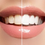 teeth whitening london