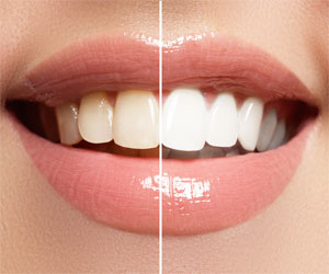 teeth whitening london