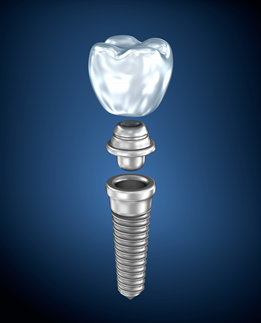 dental implant