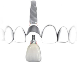 tooth implant