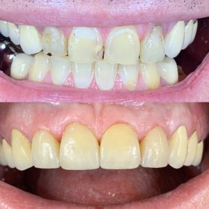 Veneers before and after