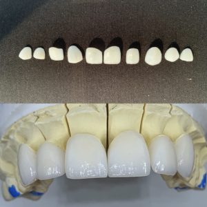 Veneers on model