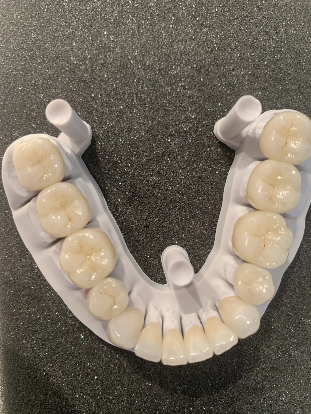Zirconia crown at Behrens Dental Practice