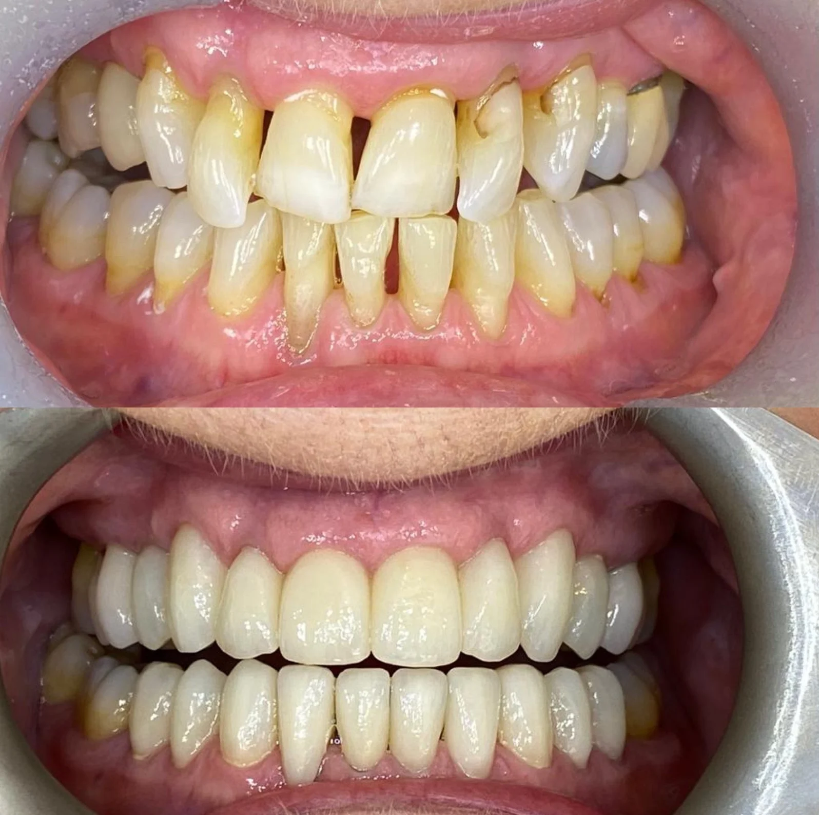 Porcelain crown — natural-looking result