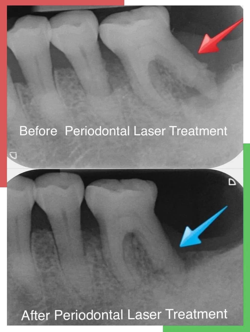 Periodontal Disease Xray