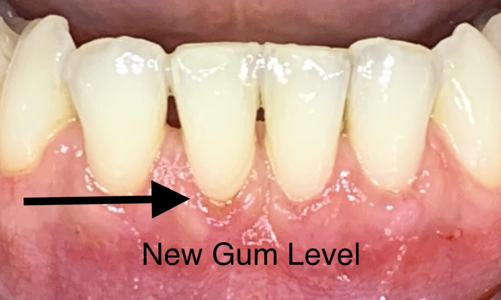 Gum Grafting Result