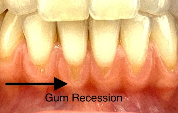 Gum Recession Lower Front