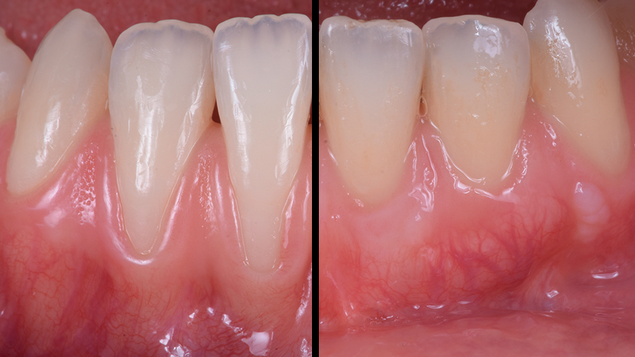 lower front teeth gum grafting