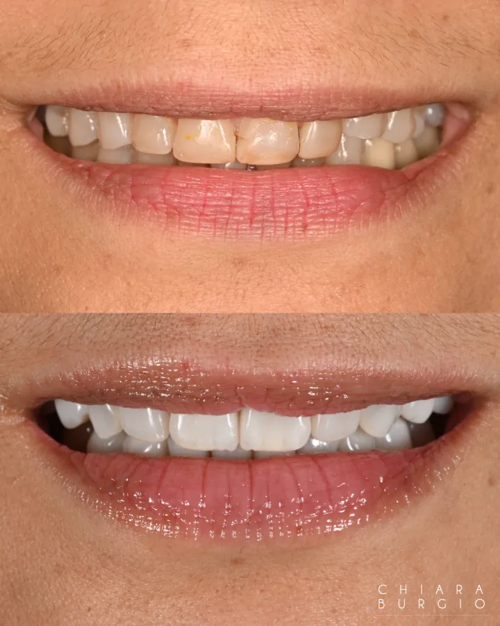 Smile Makeover Before & After