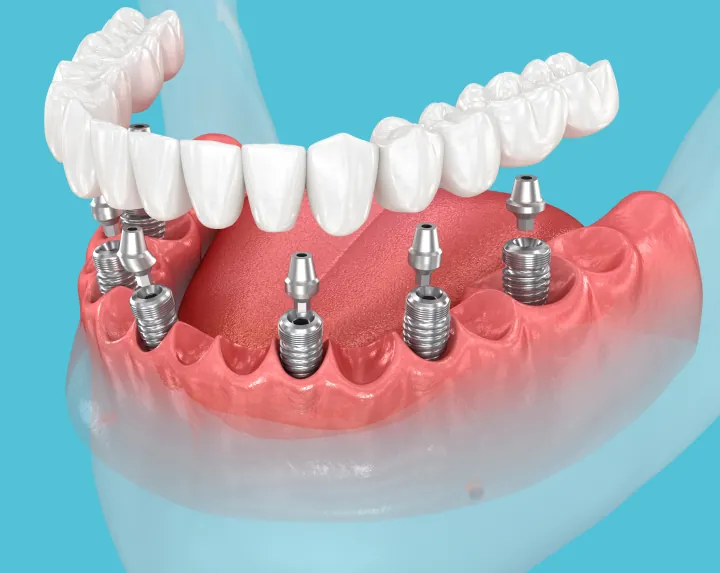 A Complete New Smile
