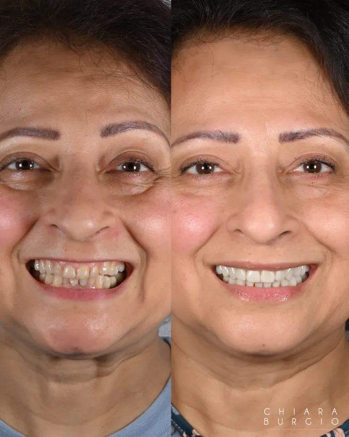 Smile Makeover Before & After