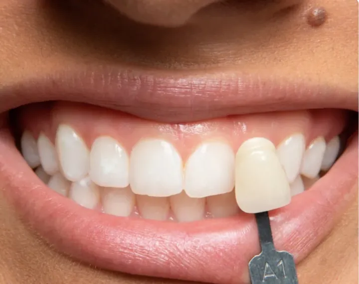 Whitening Before & After