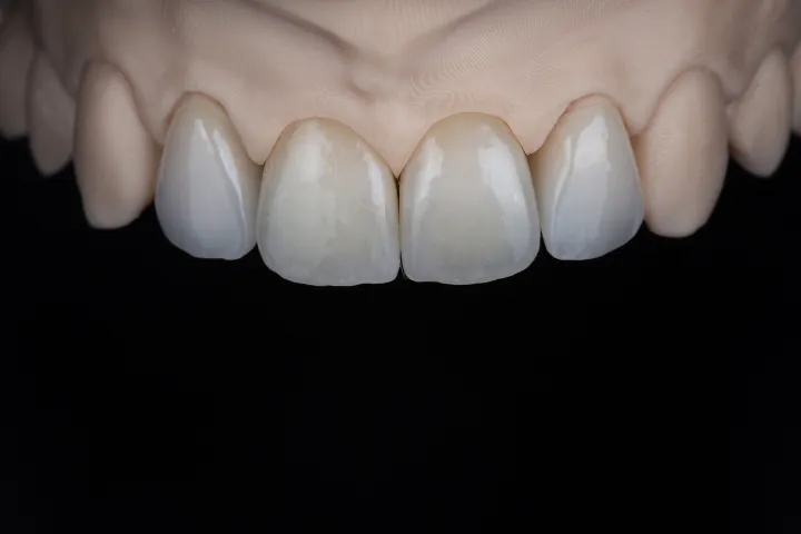 Smile Makeover Before & After