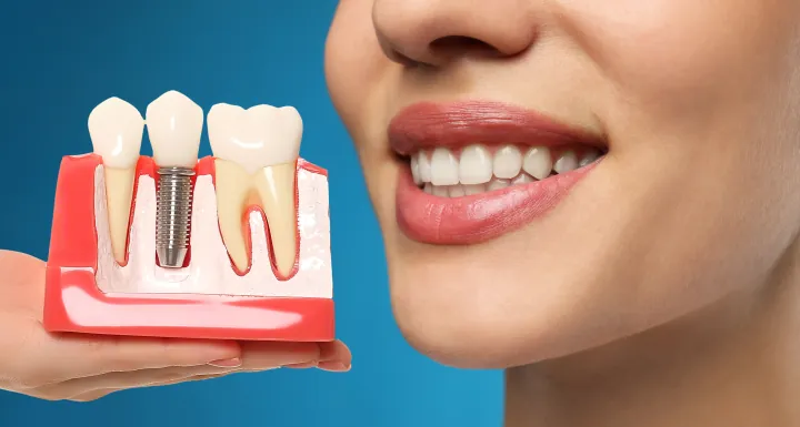 What a Dental Implant Looks Like