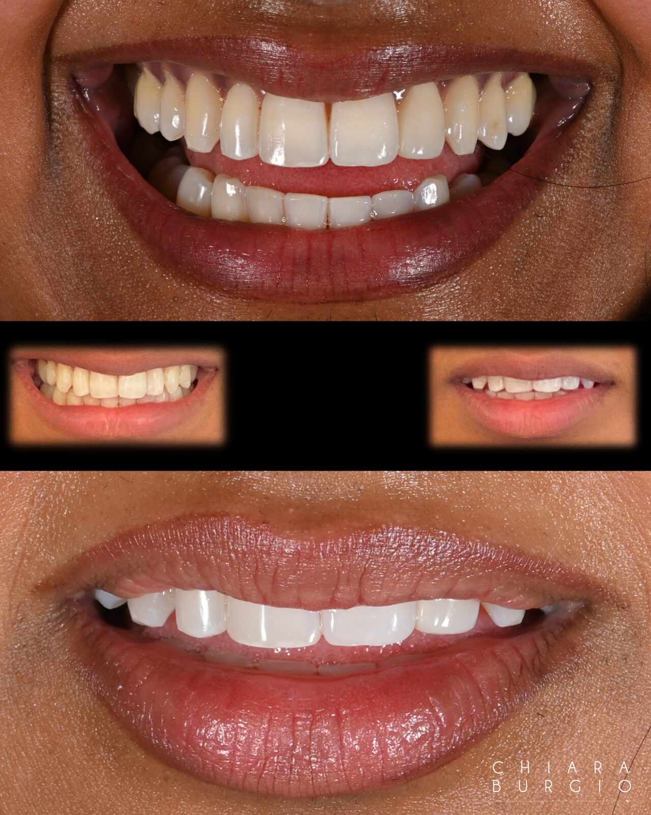Composite bonding before and after