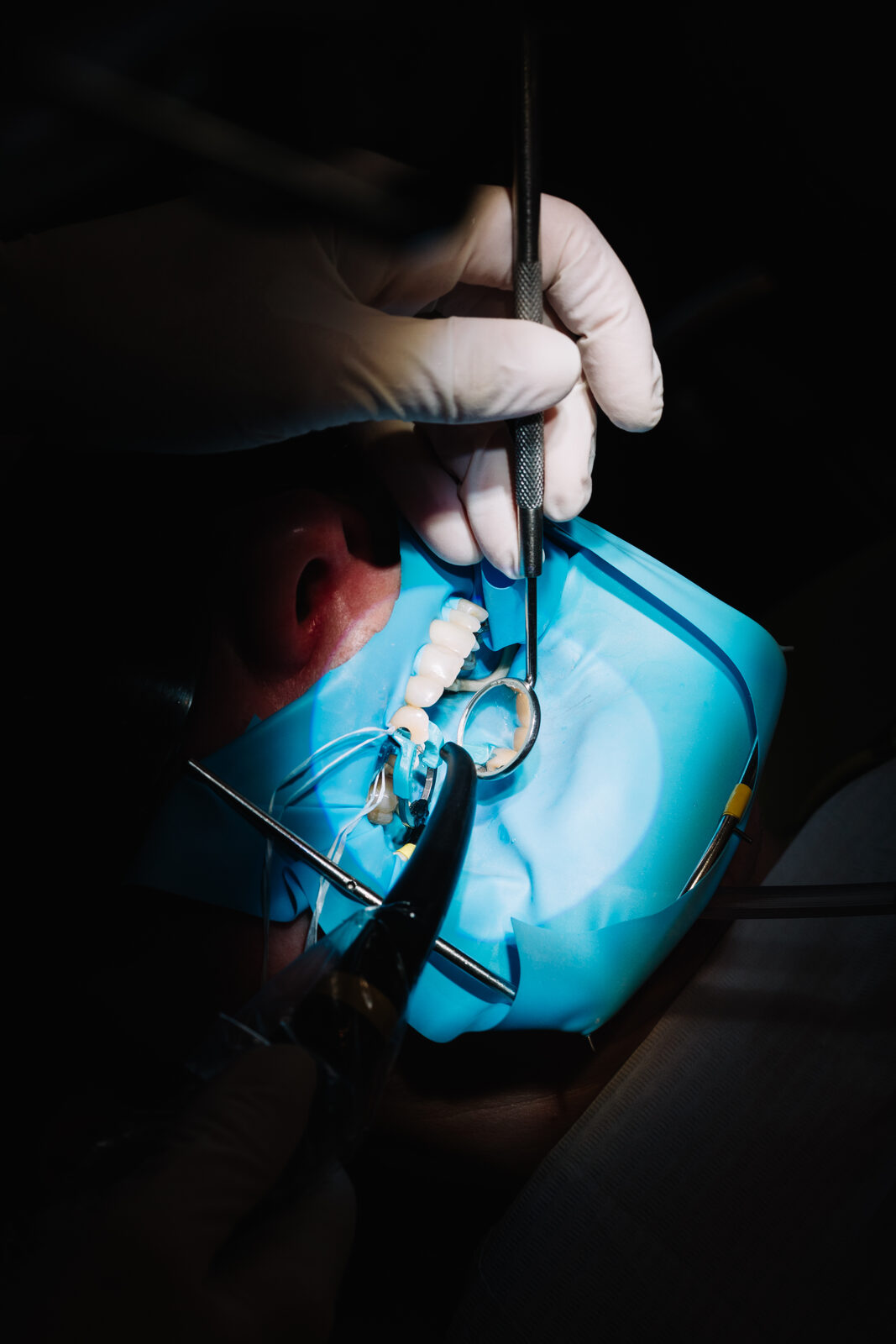 Composite bonding procedure