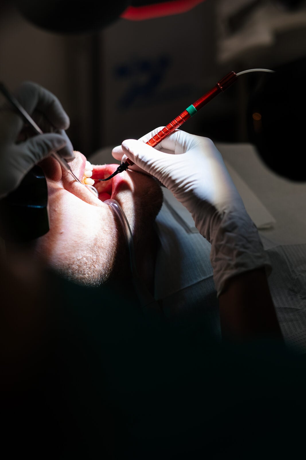 Laser gum treatment in progress at our South Kensington practice