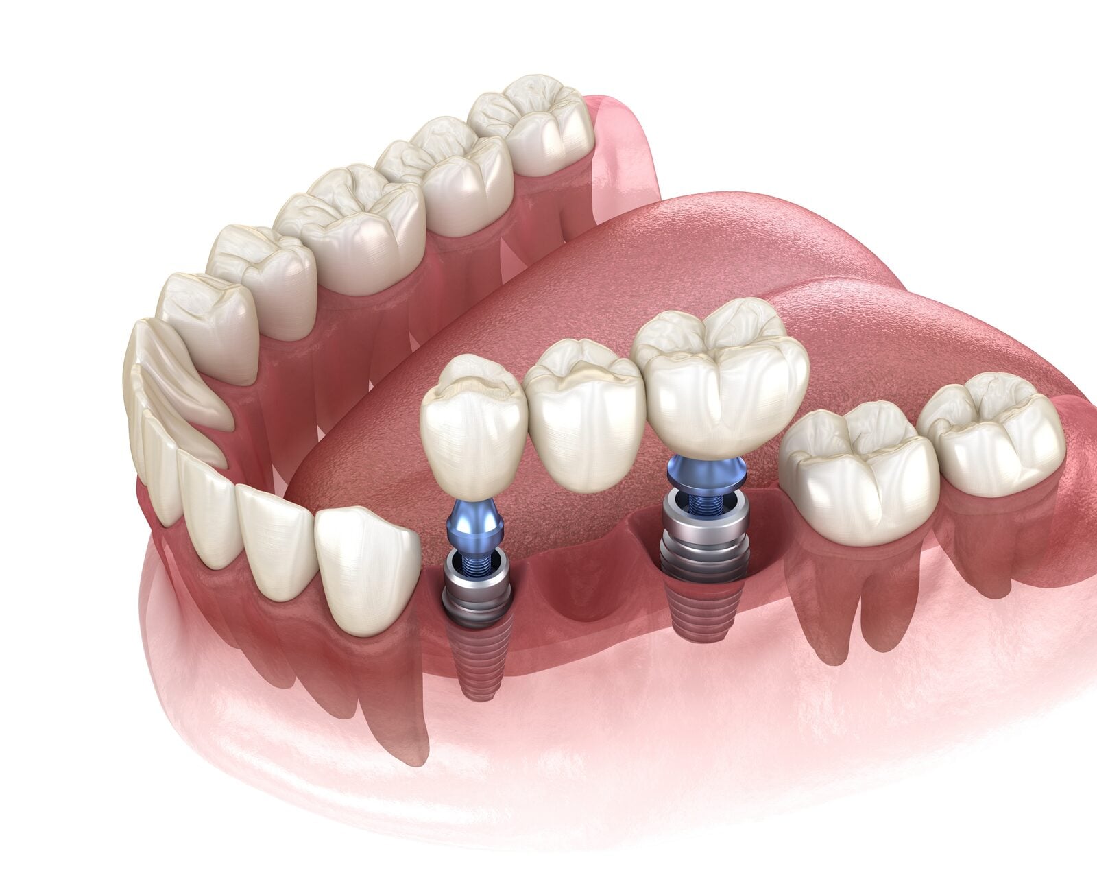 Multiple dental implants solution