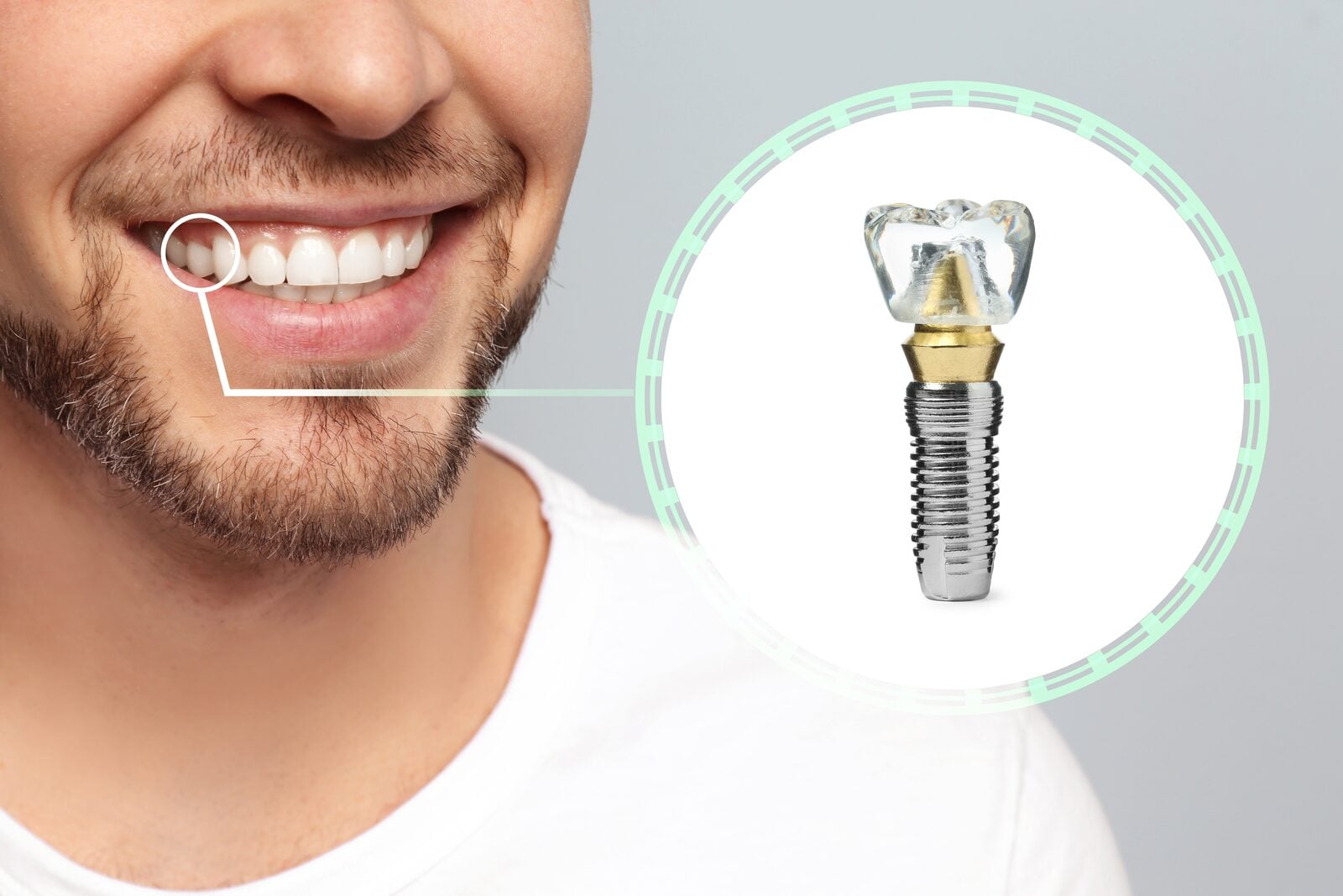 Single tooth implant — natural-looking result