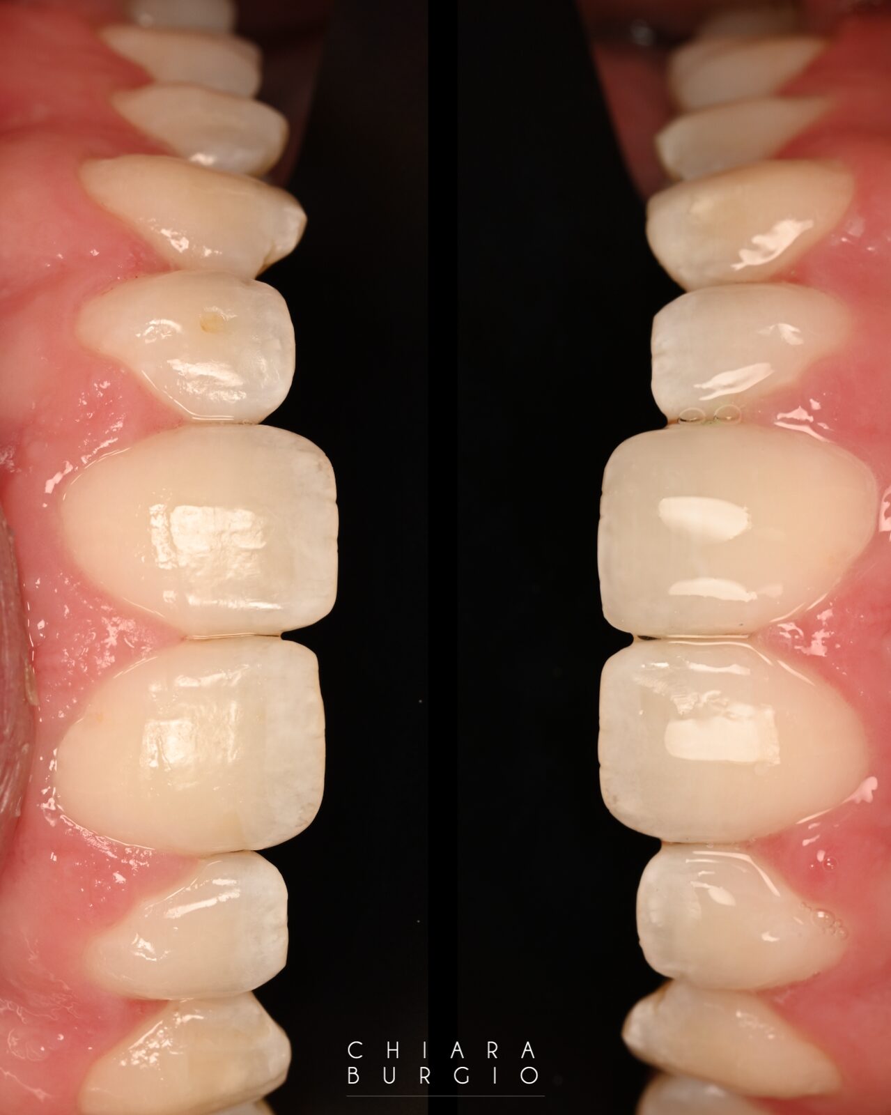 Composite bonding result